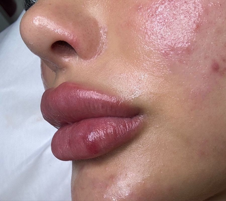 Después del tratamiento Hidra Lips en Estética SA