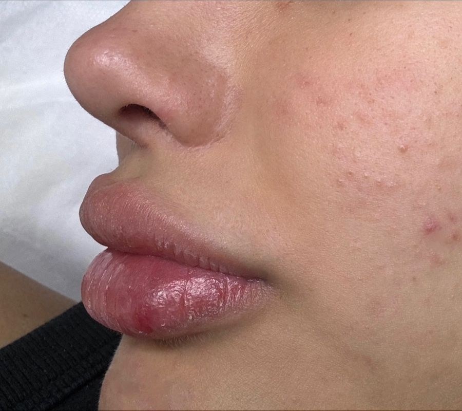 Antes del tratamiento Hidra Lips en Estética SA