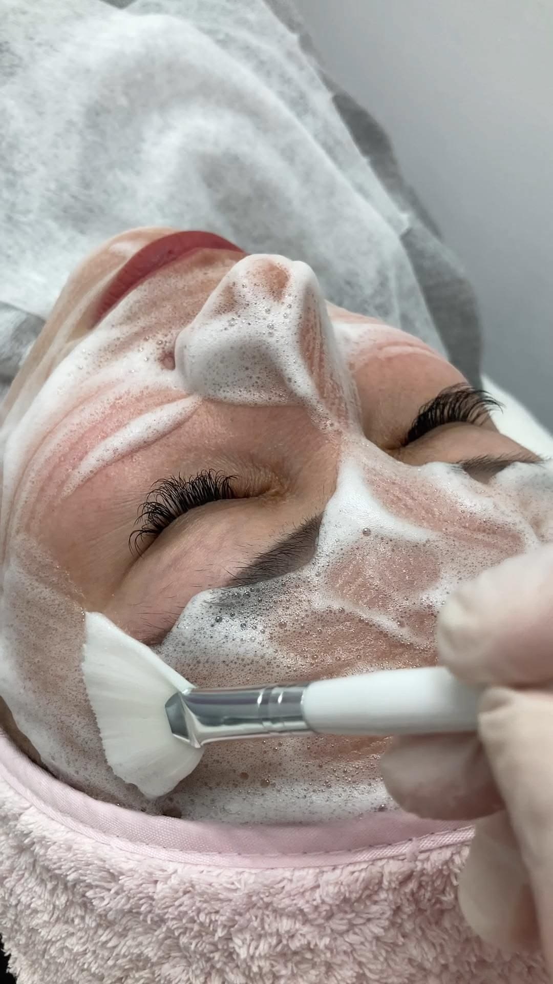 Limpieza facial profunda con espuma, primer paso del tratamiento para acné